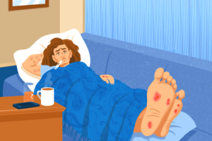 signs and symptoms of monkeypox